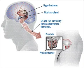 0810-PROSTATE-CANCER