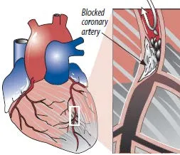 HEARTBLOCK