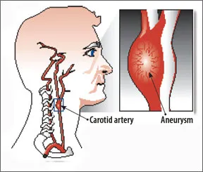 catroid_artery