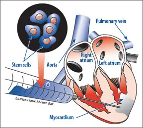 stem-cell-1107