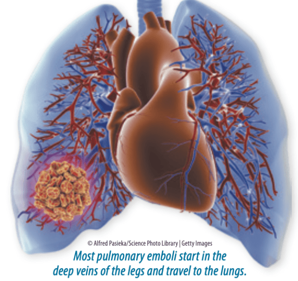 Act Swiftly to Treat a Blood Clot in Your Lungs Heart Advisor