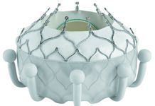 A Breakthrough Treatment for Tricuspid Valve Disease